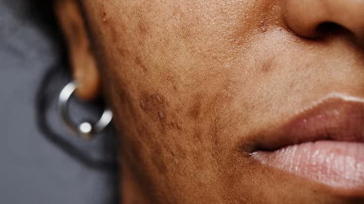 பீரியட்ஸின்போது சருமத்தில் மாற்றம்: கற்றாழை தடவலாமா?