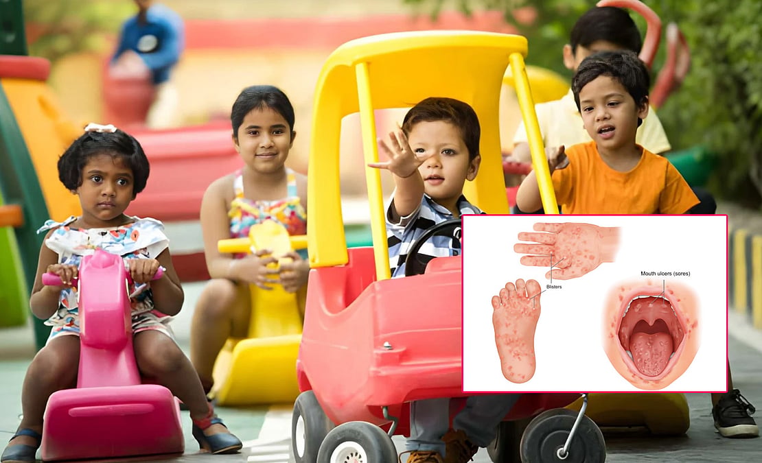குழந்தைகளிடையே கை, கால், வாய் நோய் (HFMD) பாதிப்பு அதிகரிப்பு